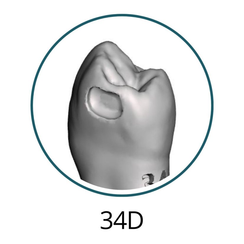 Monomaterial Teeth with Cavities (Biovoxel Typodont) - Zahn wählen: 37 Occlusal Cavity