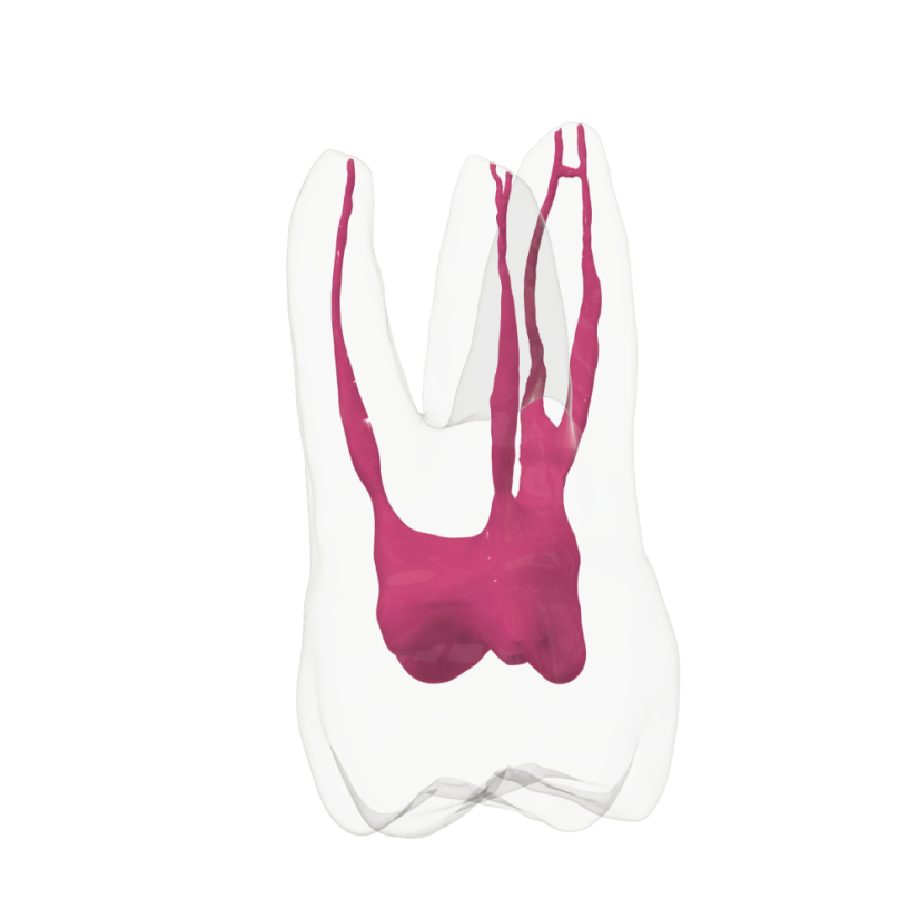 EndoTooth 16 Upper Molar (More Complex)