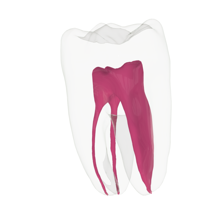 EndoTooth 36 Lower Molar (Less Complex) - Transparencia: Transparente, Acceso al diente: Intacto, no accedido