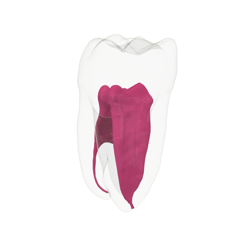 EndoTooth 37 Lower Molar (More Complex)