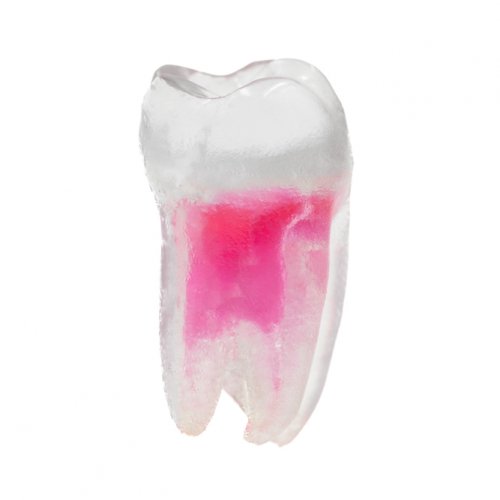 EndoTooth 37 Lower Molar (More Complex) - Trepanácia: Intaktný, netrepanovaný, Zubná dreň: S dreňou