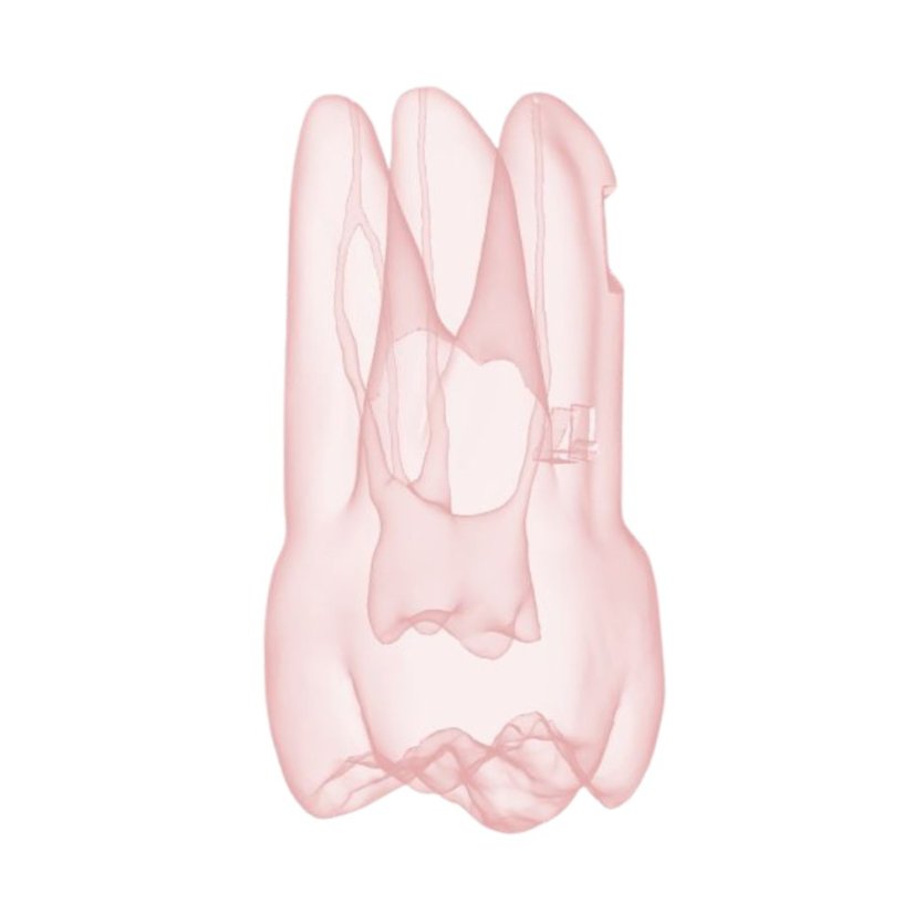 Endotooth 17 Upper Molar (Biovoxel Typodont) - Transparency: Transparent, Tooth Access: Accessed, Pulp: Without the pulp