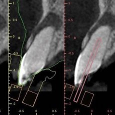 Endodontic Guide