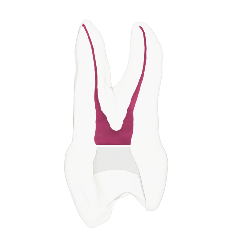 EndoTooth 14 Upper Premolar (Mesio-Occlusal access) - Transparencia: Transparente, Pulpa dental: Sin pulpa