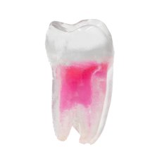 EndoTooth 37 Lower Molar (More Complex)