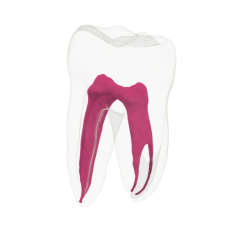 EndoTooth 37 Lower Molar (More Complex)