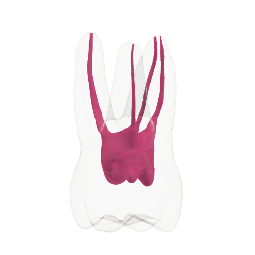 EndoTooth 16 Upper Molar (Less Complex) - Priehladnosť: Nepriehladný, Trepanácia: Trepanovaný, Zubná dreň: Bez drene