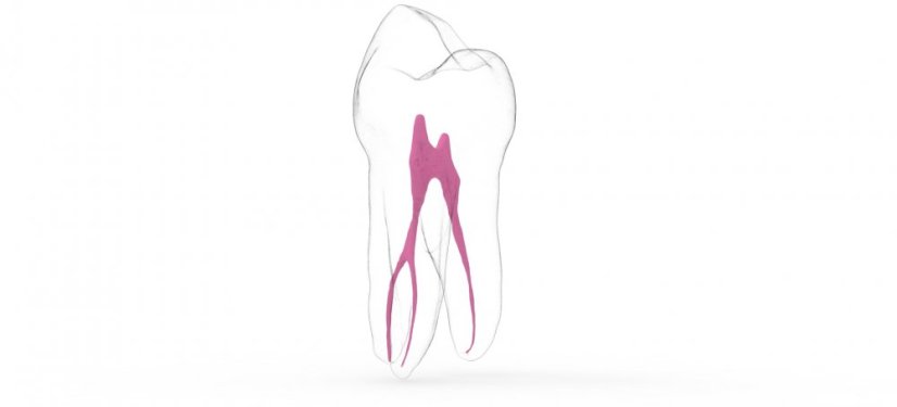 EndoTooth 14 Upper Premolar - Transparency: Transparent, Tooth Access: Accessed, Pulp: Without pulpal tissue