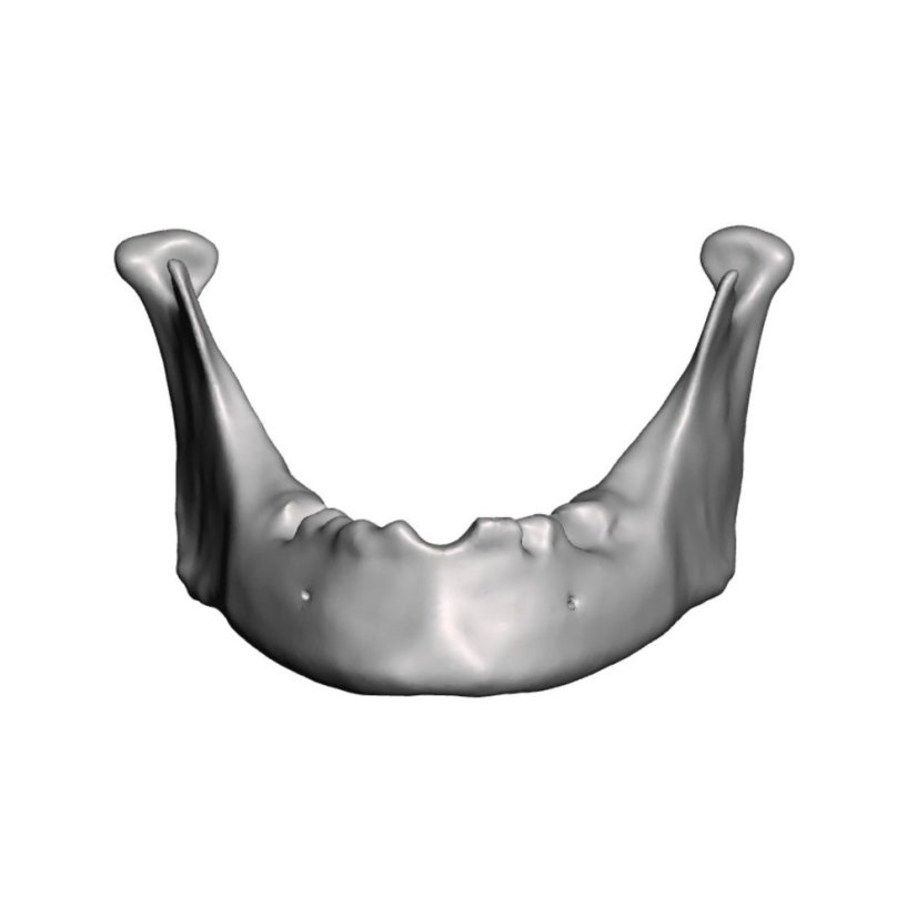 Augmentation + Implant Mandible Model