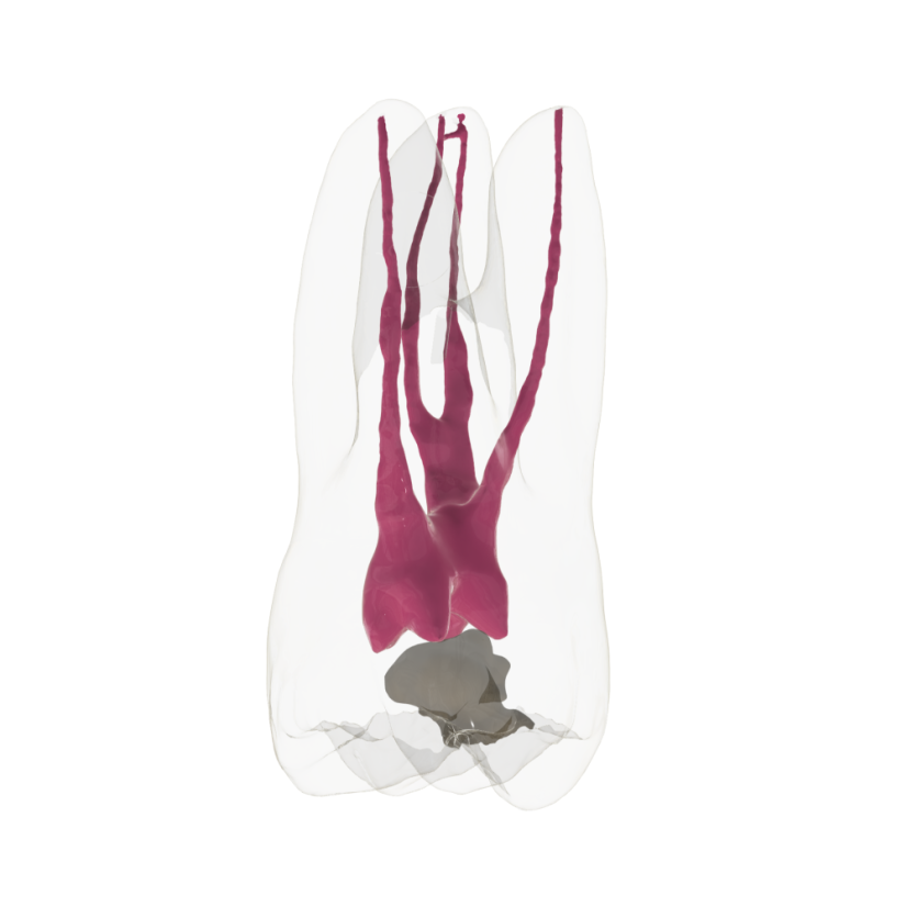 Opaque Endotooth 16 with Occlusal Caries (Biovoxel Typodont)