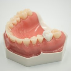 CariesTooth 16 (P-Occlusal)