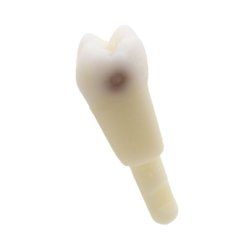 CariesTooth 36 (KaVo Analog) - Karies: Disto - Okklusal