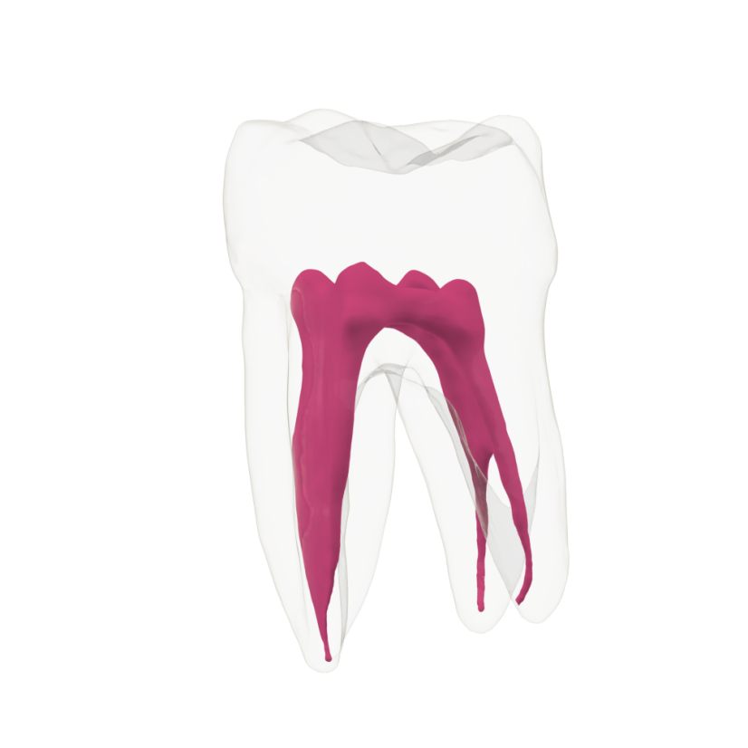 EndoTooth 37 Lower Molar (More Complex)