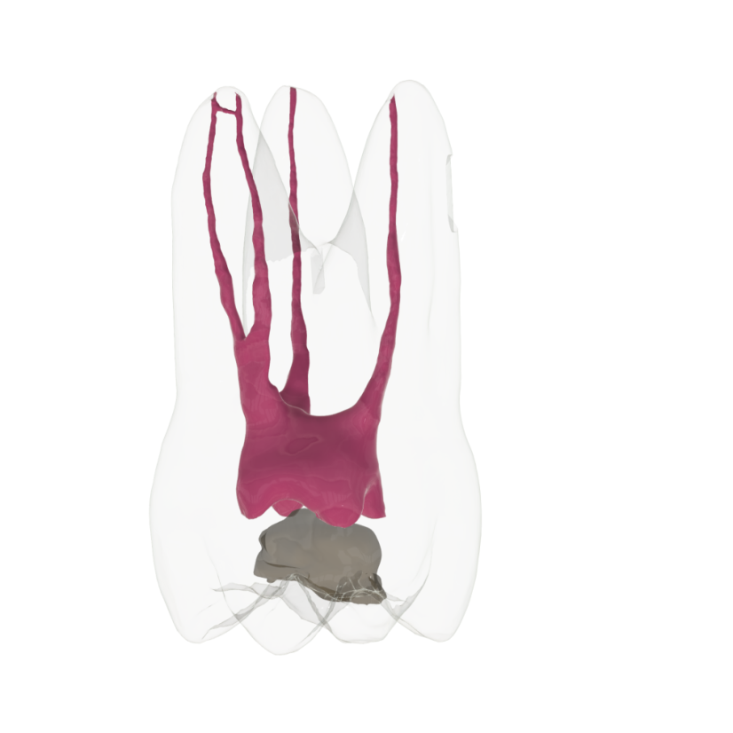 Opaque Endotooth 16 with Occlusal Caries (Biovoxel Typodont)