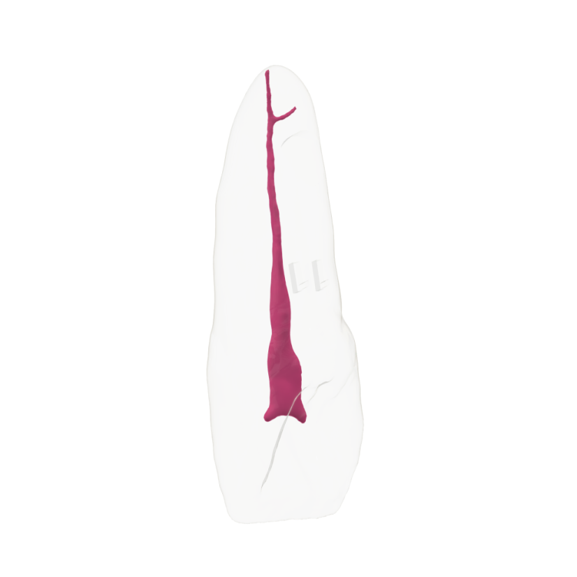 EndoTooth 11 Upper Incisor - (Biovoxel Typodont) - Durchsichtigkeit: Übersichtlich, Zugriff auf den Zahn: Zugegriffen, Zahnmark: Ohne Fruchtfleisch