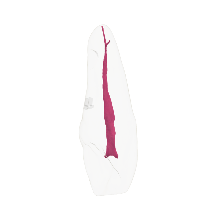 EndoTooth 11 Upper Incisor - (Biovoxel Typodont) - Durchsichtigkeit: Übersichtlich, Zugriff auf den Zahn: Zugegriffen, Zahnmark: Ohne Fruchtfleisch