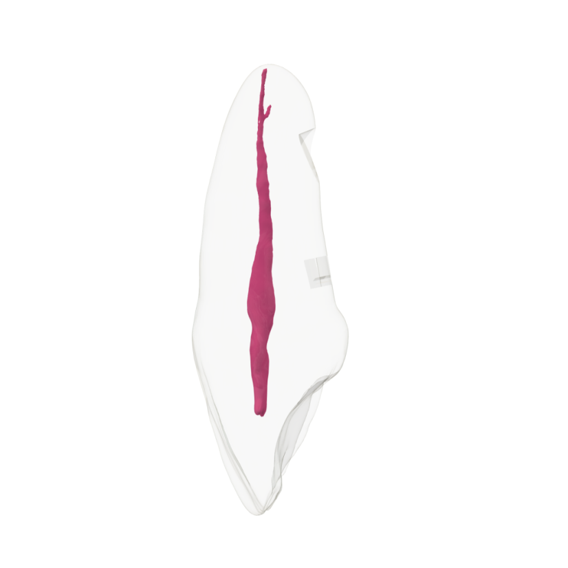 EndoTooth 11 Upper Incisor - (Biovoxel Typodont)