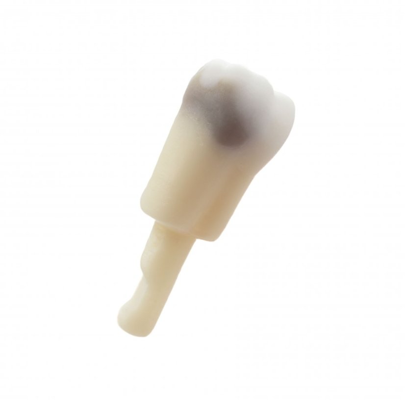 CariesTooth 46 Pre Endo (KaVo Analog)