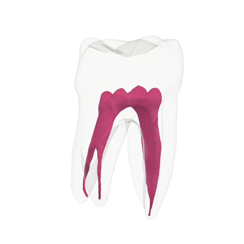 EndoTooth 37 Lower Molar (More Complex)
