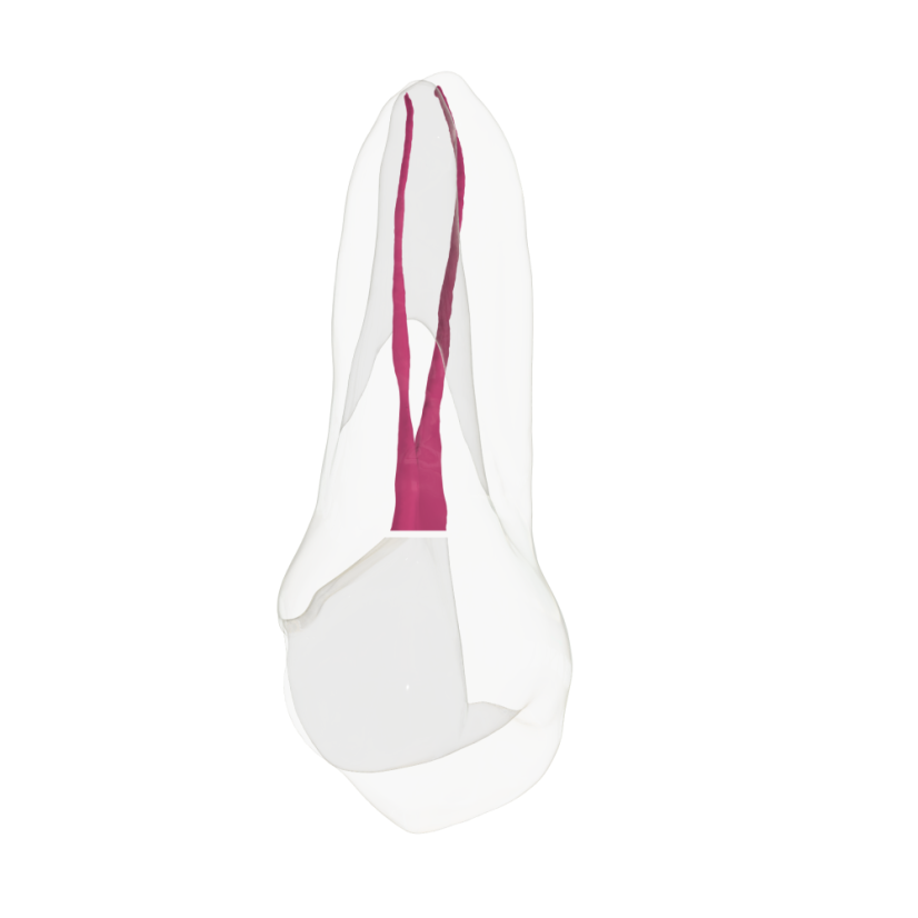 EndoTooth 14 Upper Premolar (Mesio-Occlusal access) - Transparencia: Transparente, Pulpa dental: Sin pulpa
