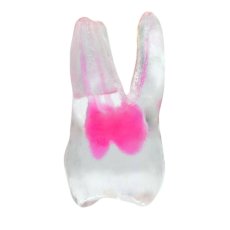 EndoTooth 16 Upper Molar (Less Complex)