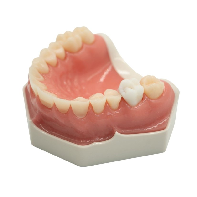 CariesTooth 16 (P-Oclusal)